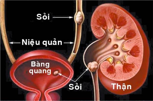 Sỏi thận